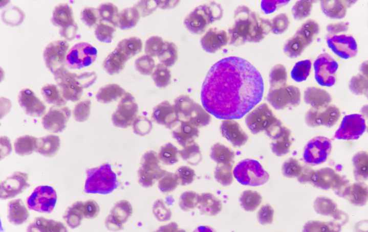 9/11 Dust Linked to Blood Mutations and Leukemia Risk