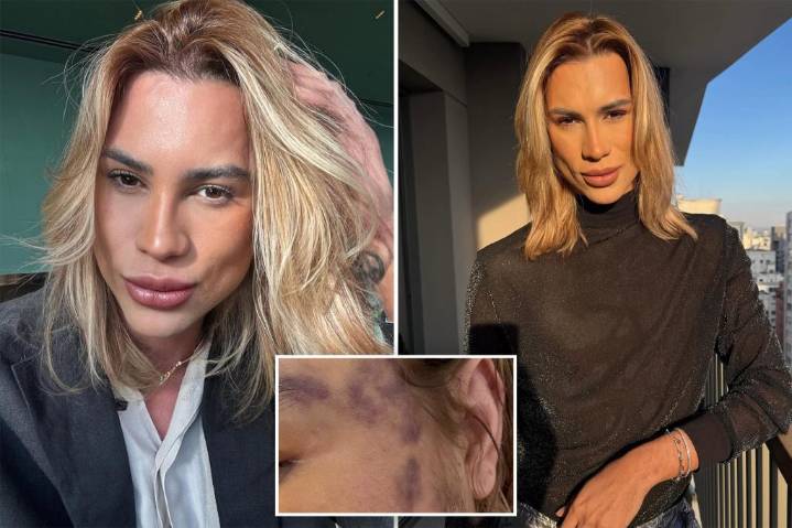 Influencer Adair Mendes Dutra dead after complaining about 'fox eyes' cosmetic surgery