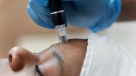 FDA warns on microneedling risks amid soaring popularity in India