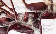 Jharkhand: Officials suspended after 5 thalassemia-affected children test HIV
