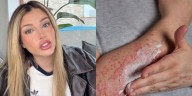 Qué es la psoriasis: qué la causa y cómo se trata la enfermedad que sufre Flavia Laos