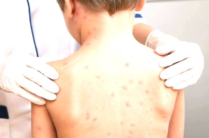 Sin casos de sarampión en la CDMX en los últimos dos meses: Sedesa