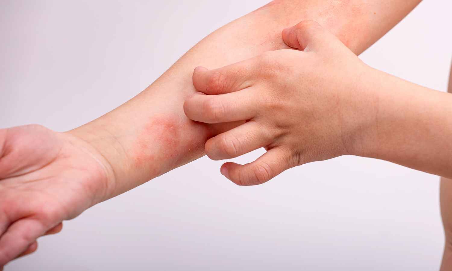 Frequent Flares Signal Worse Disease Course in Atopic Dermatitis, Machine Learning Study Finds