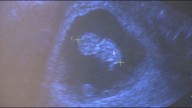 Supporters, opponents clash over “unborn child protection act” in South Carolina