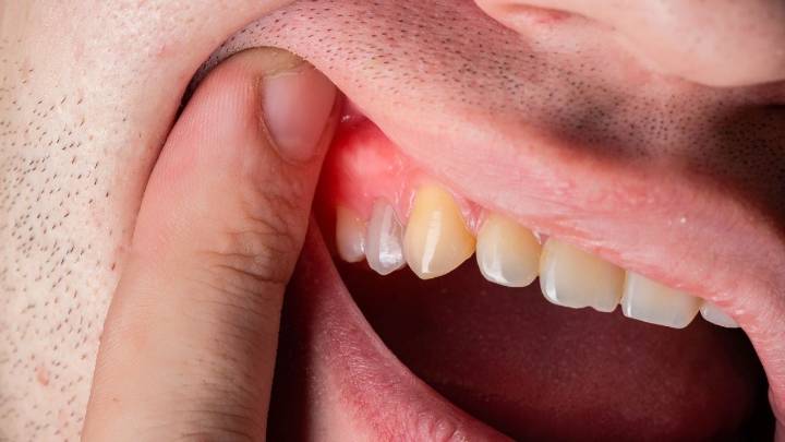 La "pista" en tu boca que podría avisar de un cáncer de próstata, según un nuevo estudio