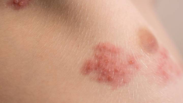 Shingles Shots Don’t Just Prevent Pain—They Might Save Your Life
