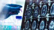 Científicos visualizan por primera vez el desencadenante del párkinson en el cerebro