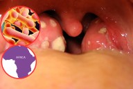 resurge la difteria en áfrica: una enfermedad mortal que vuelve a causar alarma