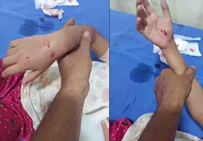 Surathkal: Stray dog attack leaves nine-year-old girl seriously i...