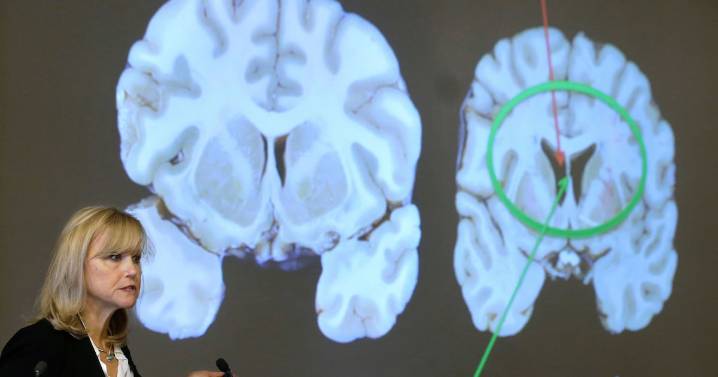 Hidden genetic damage is part of CTE: study