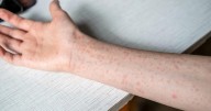 Measles case reported at Twin Cities International Schools