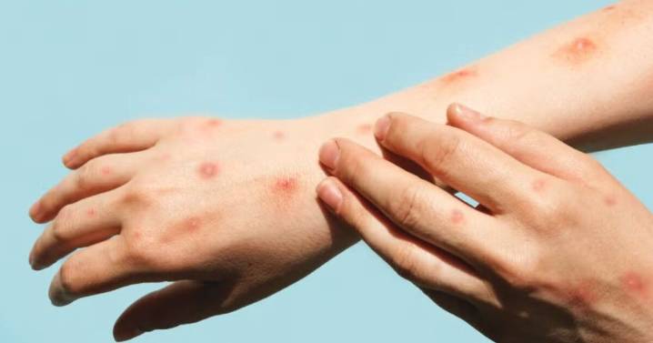 Aumentan casos de Viruela del mono en estos estados de México en 2025: ¿cómo empieza y cuáles son los síntomas? Así se contagia
