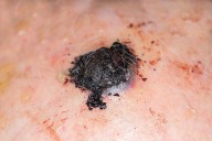Gene Test Might Spare Biopsy Surgery For Some Melanoma Patients