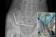 13-year-old boy has emergency surgery after swallowing 100 magnets