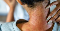 What Is Eczema and How Can You Treat it?