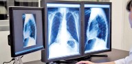 Descubren circuito molecular que controla la regeneración del pulmón