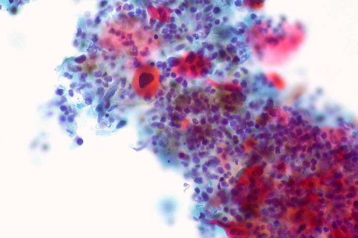 ‘Incredibly Encouraging’ Drug Trial Shrinks Tumors in Head and Neck Cancer Patients Within Six Weeks