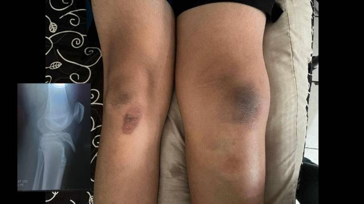 Saltillo: estudiante sufre grave lesión en instituto; familia denuncia negligencia