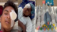 Over 60 injured, several children lose eyesight in Bhopal 'Carbide Gun'