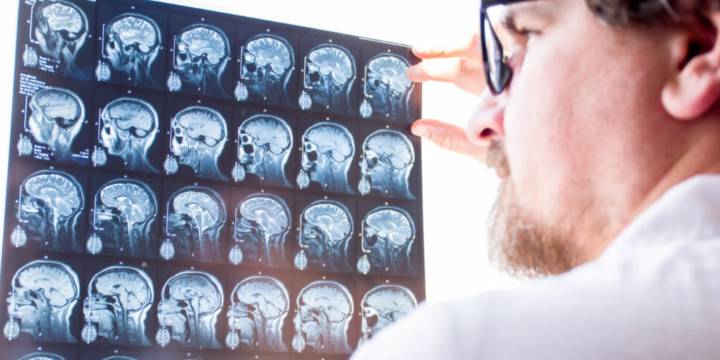 Herramienta de IA es capaz de detectar pequeñas malformaciones cerebrales difíciles de identificar en niños con epilepsia