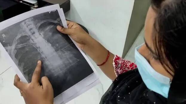 Guide wire left in woman's chest during surgery; Police to form special medical board