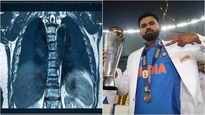 Blunt trauma explained: How abdominal injury like Shreyas Iyer’s can affect athletes