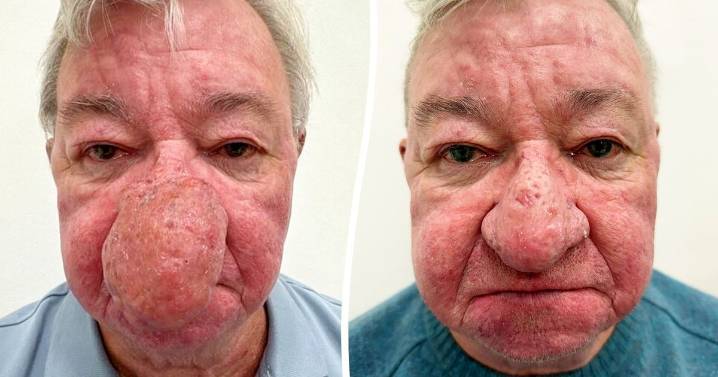 Man couldn't kiss wife because nose kept 'growing and growing'