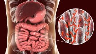 El sobrecrecimiento bacteriano del intestino delgado, una dolencia al alza