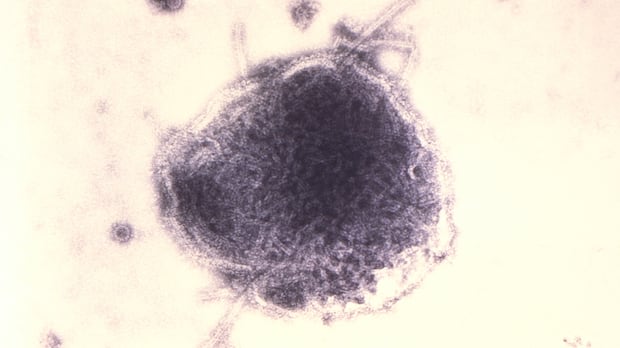Nearly 90% of Manitoba's reported measles cases involved unvaccinated patients: public health