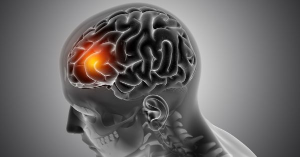 Día Mundial del ACV: los primeros síntomas en jóvenes que son claves para identificarlo a tiempo