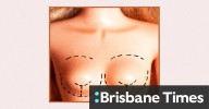Breast implant explant trend: Alyssa Milano and other celebrities ditching large implants like those of Kylie Jenner for smaller, natural look