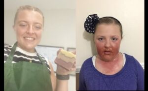 Arbon Valley woman turns painful skin allergies into all