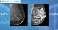Doctors using AI mammogram readings to predict breast cancer risk