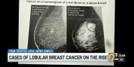 Iowa doctor says a lesser-known type of breast cancer is on the rise