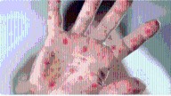 Tomato flu alert in Uttarakhand: 28 child cases confirmed, health dept issues warning
