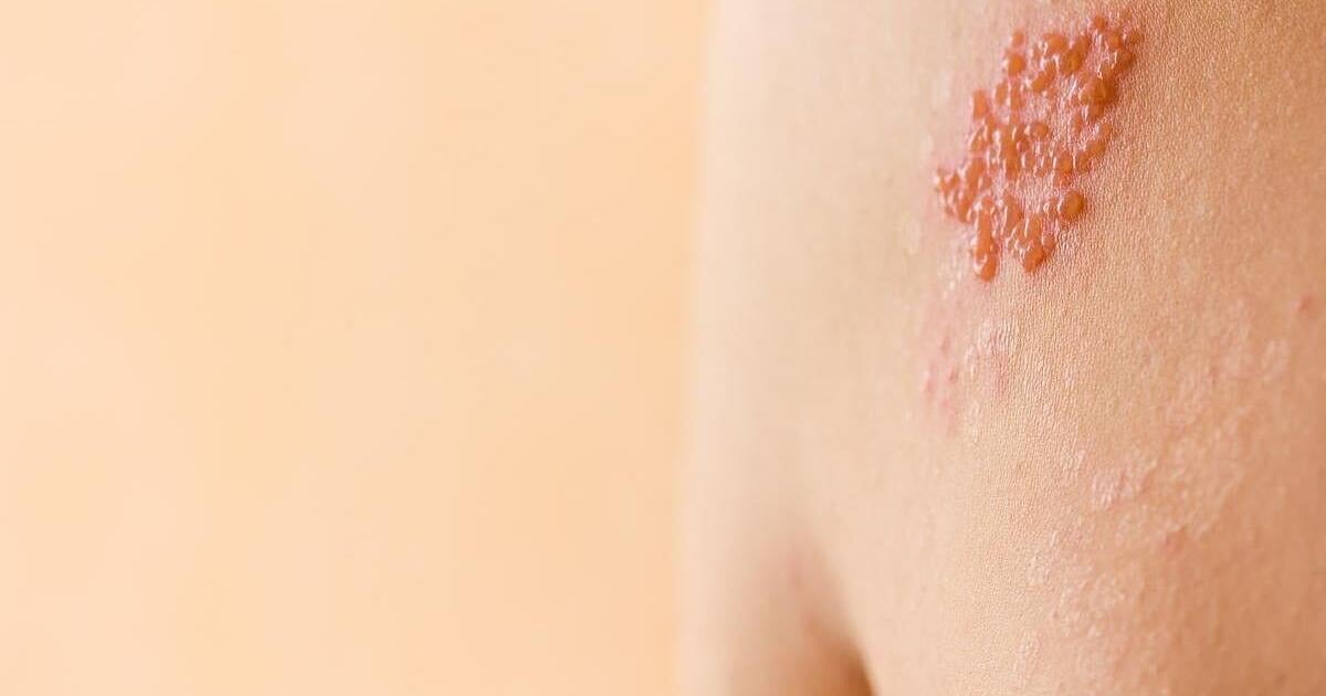 Shingles Vax Protects Against Heart Disease, Dementia, Death