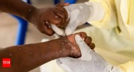 Severe mpox strain spreading in US: What is it and how to stay safe