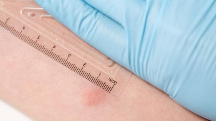 Tuberculosis exposure reported at Innovation High School in Chula Vista