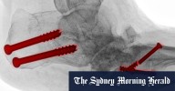 Podiatric surgeons to get new title of surgical podiatrists after patient confusion