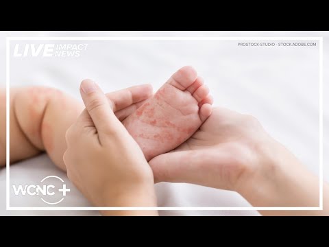 South Carolina health leaders discuss measles cases