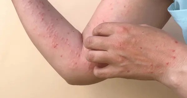 Detectan dos casos de viruela del mono en Santa Cruz y refuerzan la vigilancia epidemiológica
