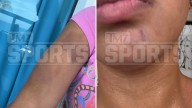 Browns' Quinshon Judkins Ex's Alleged Injury Photos Show Mark On Chin, Bruising