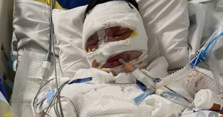 Community rallies for teen burn victim in Coonabarabran