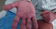 Detectan casos más severos de viruela del mono en EU; ¿son similares a los de México?
