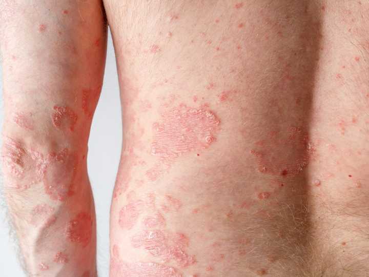 Psoriasis, más allá de la piel: cómo evitar el efecto dominó, y la diferencia clave que puede cambiar el pronóstico