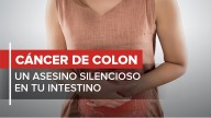 Cáncer de colon: cinco síntomas de alerta que previenen la enfermedad a tiempo