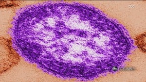 SCDPH increases measles case count by 4 to 37 total