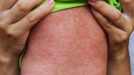 Premature baby dies of measles in Alberta outbreak's first death