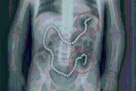 Adolescente pierde parte del intestino tras ingerir más de 100 imanes de neodimio