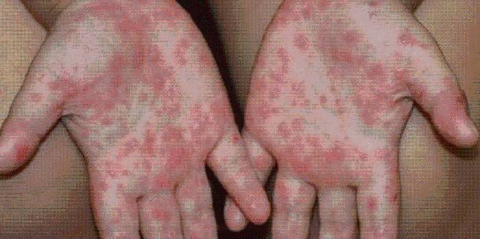 Suspenden clases en Baja California por virus Coxsackie